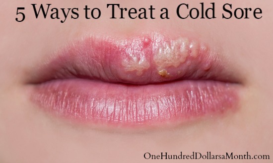 How to Treat a Cold Sore