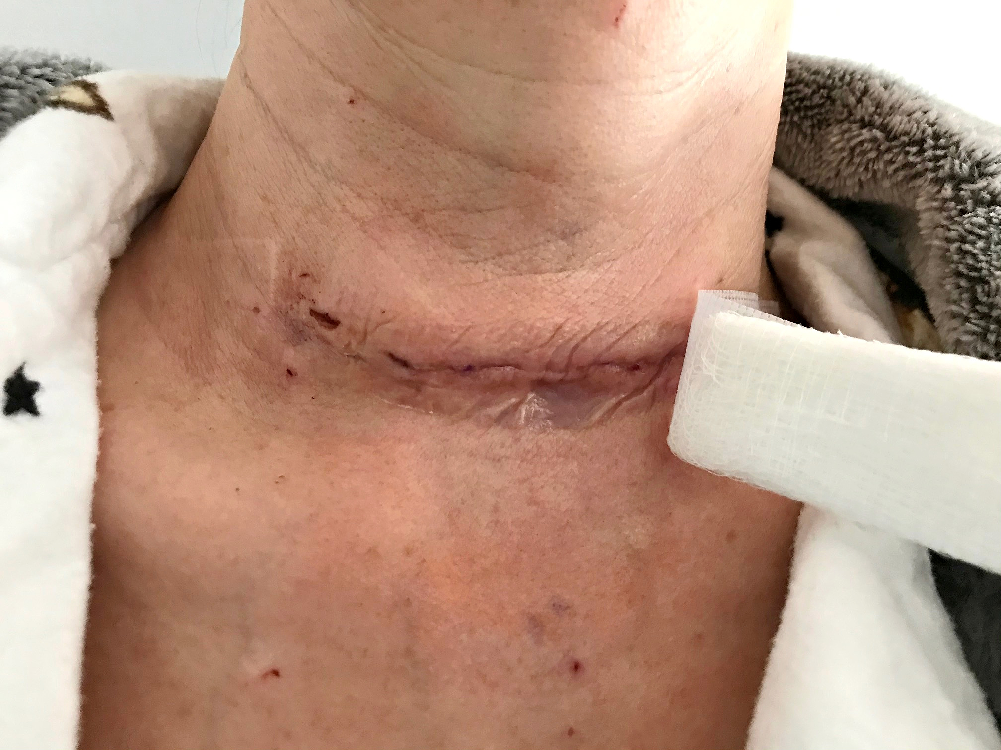 My Total Thyroidectomy 1 Week Post Op